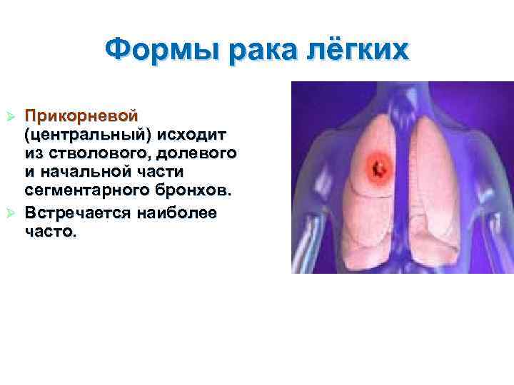 Формы рака лёгких Прикорневой (центральный) исходит из стволового, долевого и начальной части сегментарного бронхов.