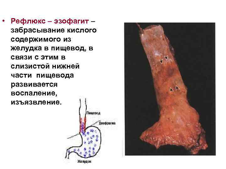  • Рефлюкс – эзофагит – забрасывание кислого содержимого из желудка в пищевод, в
