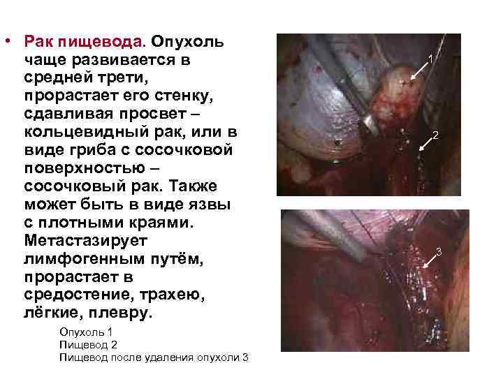  • Рак пищевода. Опухоль чаще развивается в средней трети, прорастает его стенку, сдавливая