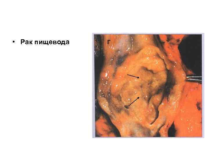  • Рак пищевода 
