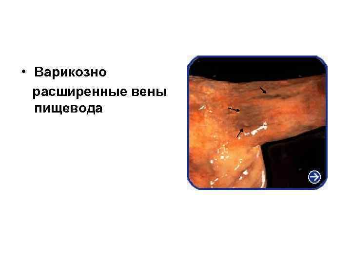  • Варикозно расширенные вены пищевода 