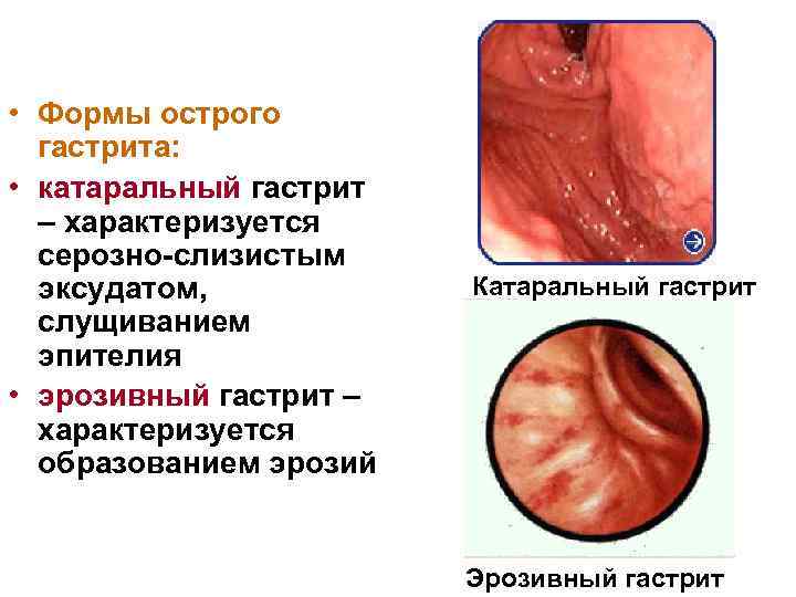  • Формы острого гастрита: • катаральный гастрит – характеризуется серозно-слизистым эксудатом, слущиванием эпителия