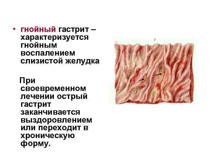  • гнойный гастрит – характеризуется гнойным воспалением слизистой желудка При своевременном лечении острый