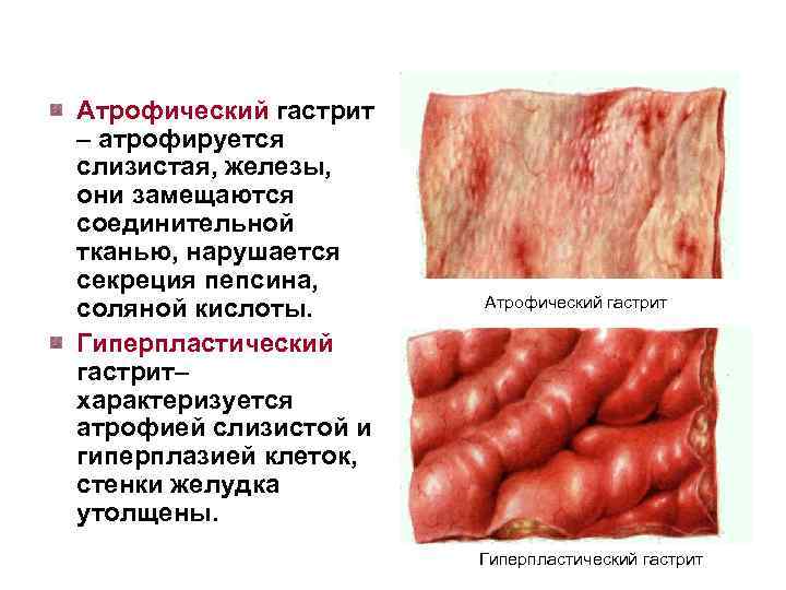 Атрофический гастрит – атрофируется слизистая, железы, они замещаются соединительной тканью, нарушается секреция пепсина, соляной