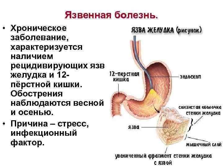 Клиническая картина ябж