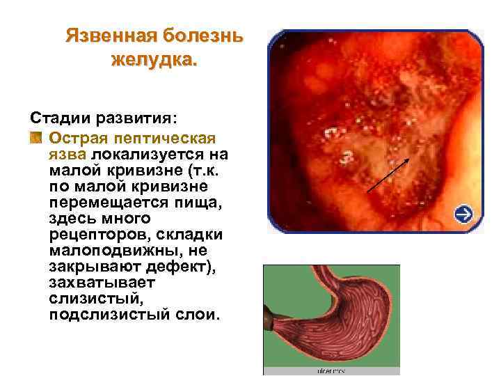 Язвенная болезнь желудка. Стадии развития: Острая пептическая язва локализуется на малой кривизне (т. к.