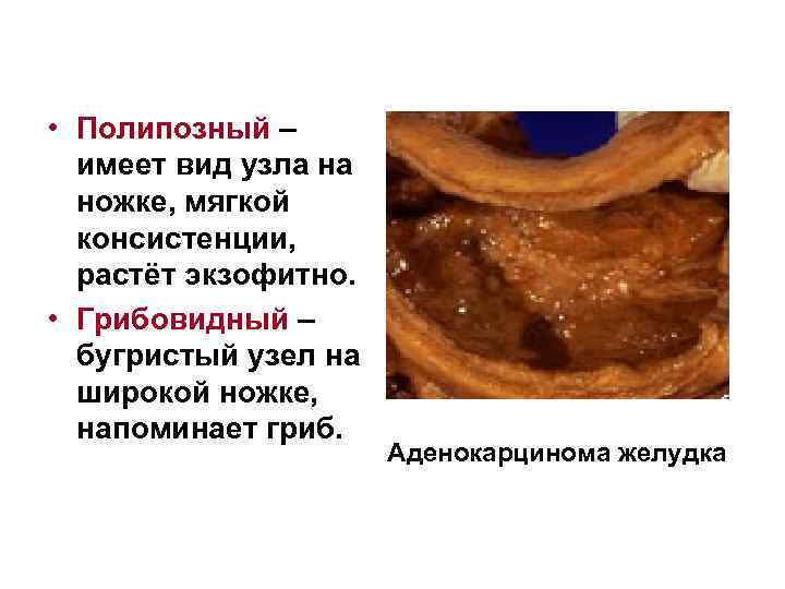  • Полипозный – имеет вид узла на ножке, мягкой консистенции, растёт экзофитно. •