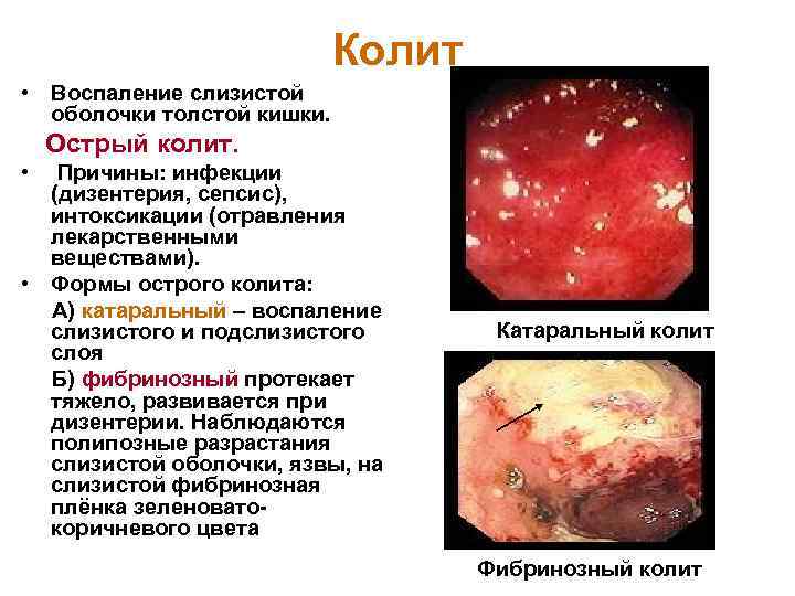 Колит • Воспаление слизистой оболочки толстой кишки. Острый колит. • Причины: инфекции (дизентерия, сепсис),