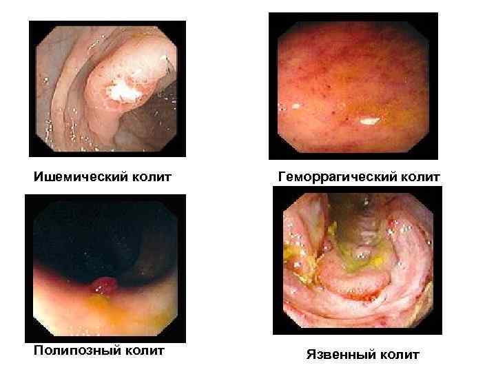 Ишемический колит Геморрагический колит Полипозный колит Язвенный колит 