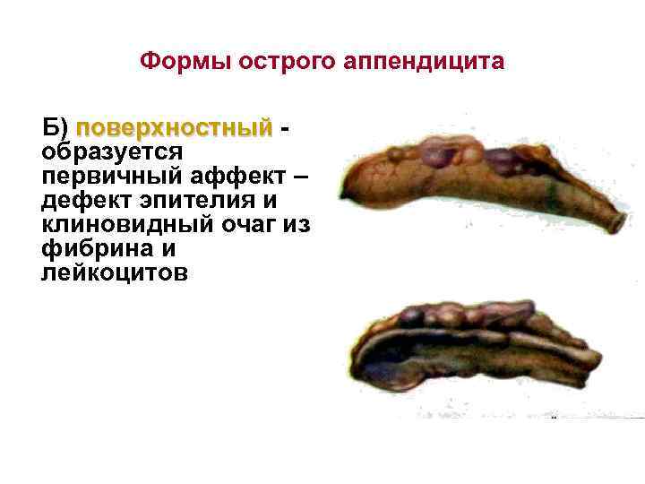 Формы острого аппендицита Б) поверхностный образуется первичный аффект – дефект эпителия и клиновидный очаг