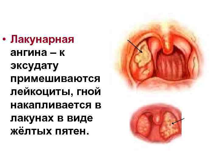  • Лакунарная ангина – к эксудату примешиваются лейкоциты, гной накапливается в лакунах в