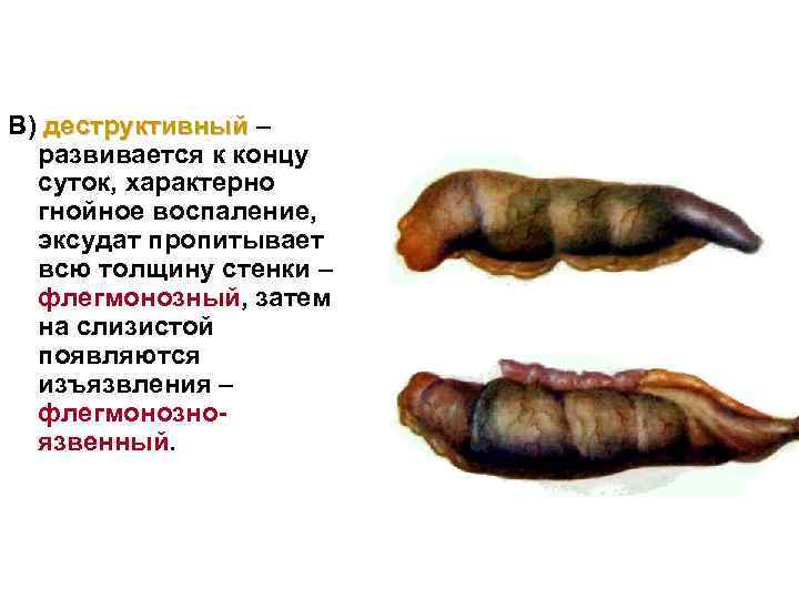 В) деструктивный – развивается к концу суток, характерно гнойное воспаление, эксудат пропитывает всю толщину