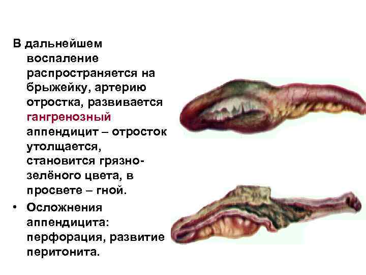 В дальнейшем воспаление распространяется на брыжейку, артерию отростка, развивается гангренозный аппендицит – отросток утолщается,