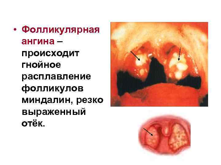 • Фолликулярная ангина – происходит гнойное расплавление фолликулов миндалин, резко выраженный отёк. 