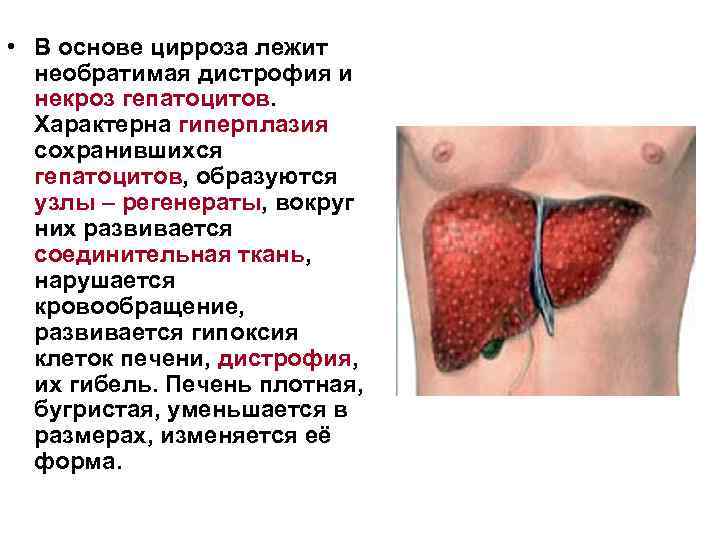  • В основе цирроза лежит необратимая дистрофия и некроз гепатоцитов. Характерна гиперплазия сохранившихся