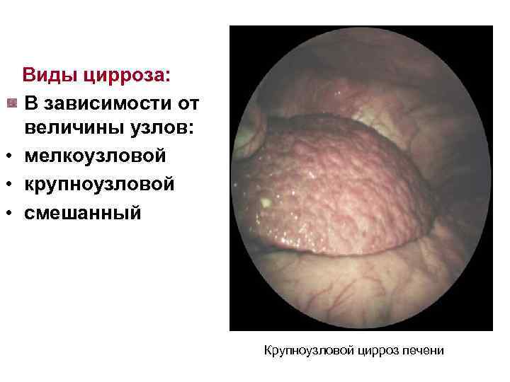 Виды цирроза: В зависимости от величины узлов: • мелкоузловой • крупноузловой • смешанный Крупноузловой