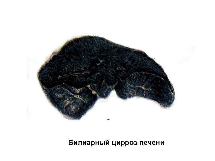 Билиарный цирроз печени 