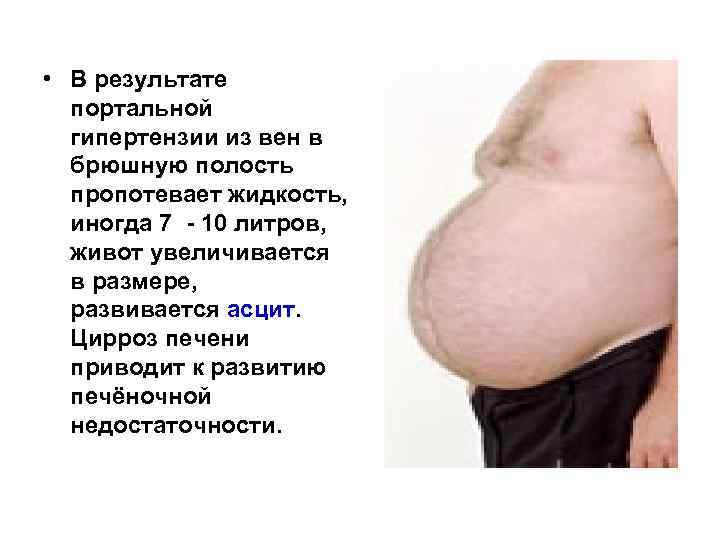  • В результате портальной гипертензии из вен в брюшную полость пропотевает жидкость, иногда