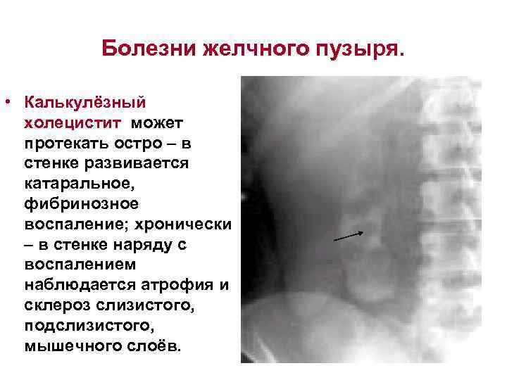 Болезни желчного пузыря. • Калькулёзный холецистит может протекать остро – в стенке развивается катаральное,