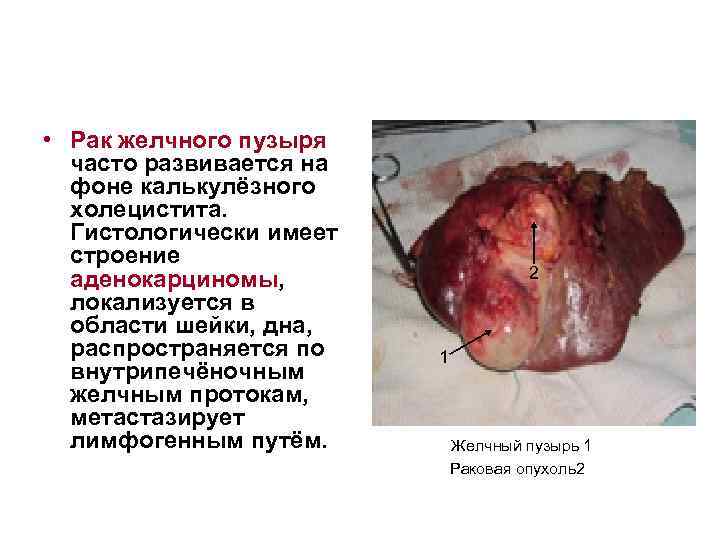  • Рак желчного пузыря часто развивается на фоне калькулёзного холецистита. Гистологически имеет строение