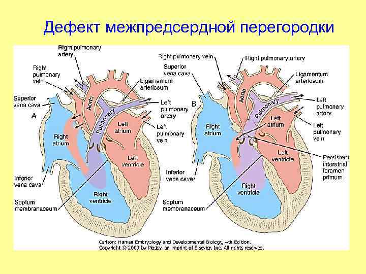 Дефект межпредсердной перегородки 