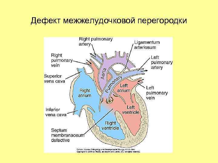 Дефект межжелудочковой перегородки 