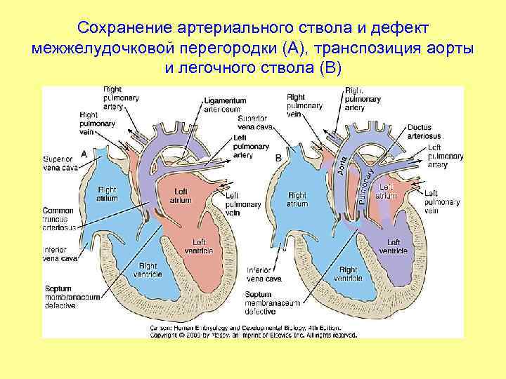 Сохранение артериального ствола и дефект межжелудочковой перегородки (А), транспозиция аорты и легочного ствола (В)