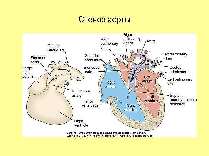 Стеноз аорты 