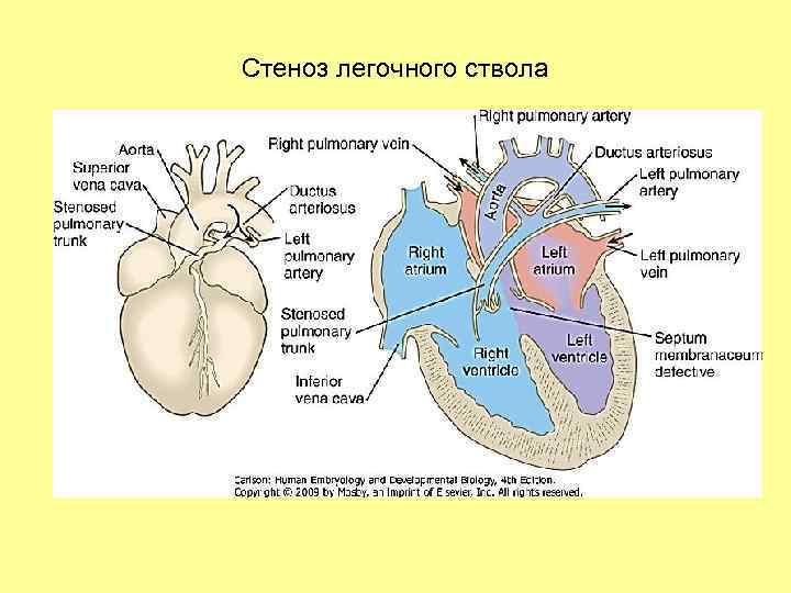 Стеноз легочного ствола 