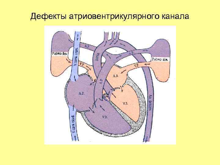 Дефекты атриовентрикулярного канала 