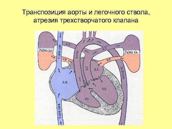 Атрезия трехстворчатого клапана презентация