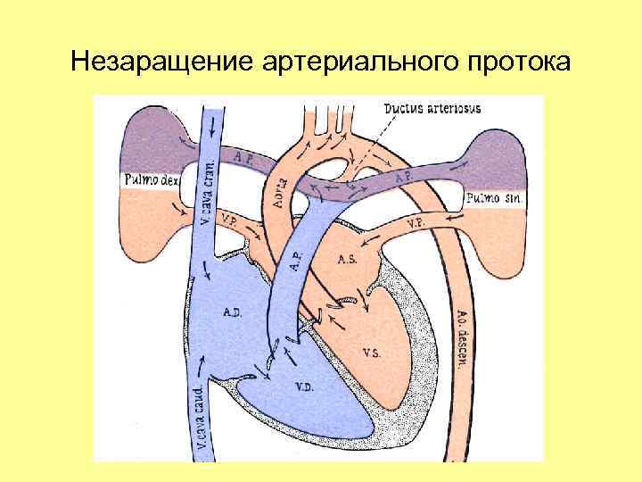 Незаращение артериального протока 