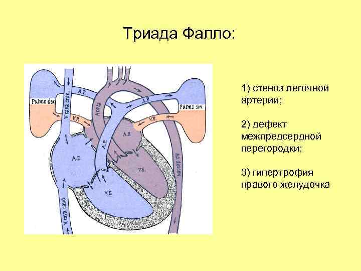 Для аускультативной картины дмпп характерно