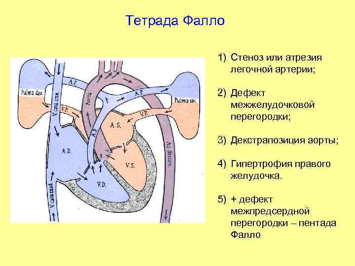 Тетрада Фалло 1) Стеноз или атрезия легочной артерии; 2) Дефект межжелудочковой перегородки; 3) Декстрапозиция