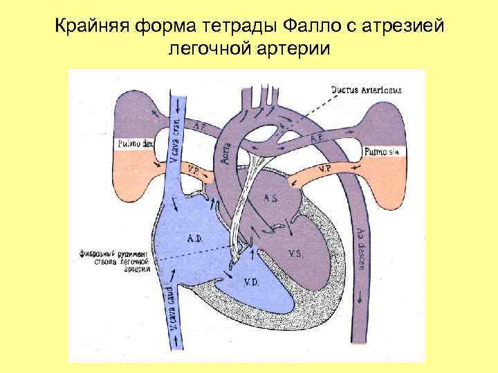 Крайняя форма тетрады Фалло с атрезией легочной артерии 