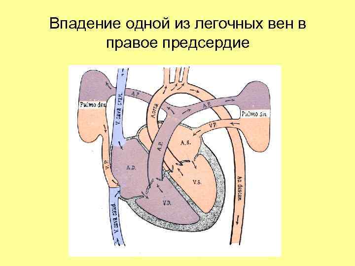 Впадение одной из легочных вен в правое предсердие 