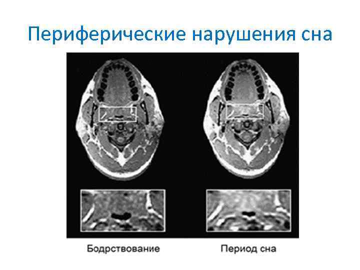 Периферические нарушения сна 