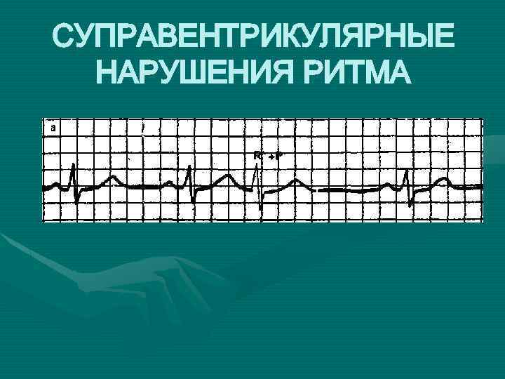 СУПРАВЕНТРИКУЛЯРНЫЕ НАРУШЕНИЯ РИТМА 