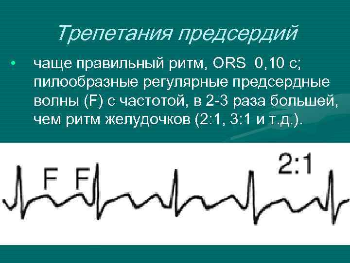 Типы трепетания предсердий