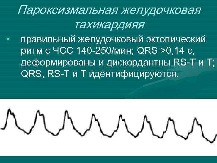  • Пароксизмальная желудочковая тахикардияя правильный желудочковый эктопический ритм с ЧСС 140 -250/мин; QRS