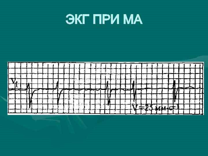 ЭКГ ПРИ МА 