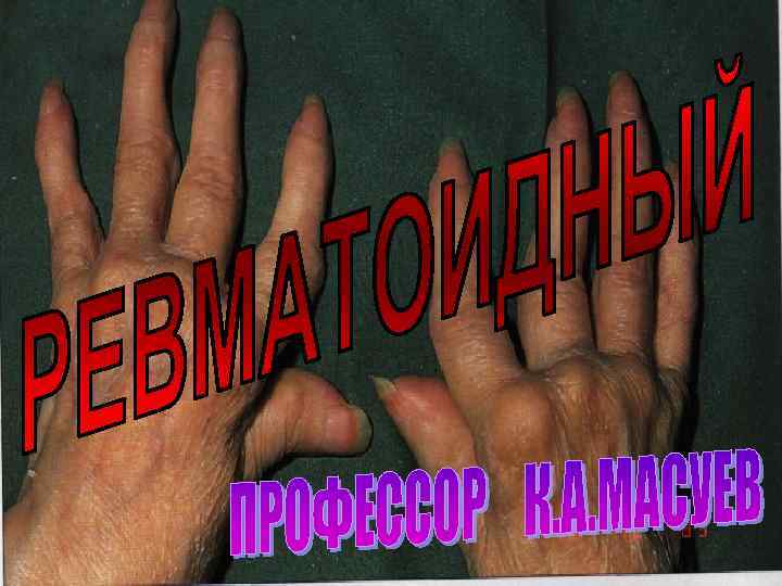 РЕВМАТОИДНЫЙ АРТРИТ ПРОФЕССОР МАСУЕВ К. А. 