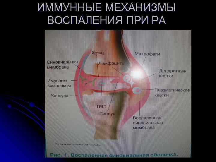 ИММУННЫЕ МЕХАНИЗМЫ ВОСПАЛЕНИЯ ПРИ РА 