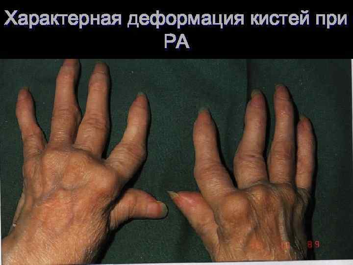 Характерная деформация кистей при РА 