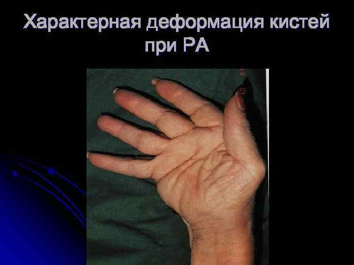 Характерная деформация кистей при РА 