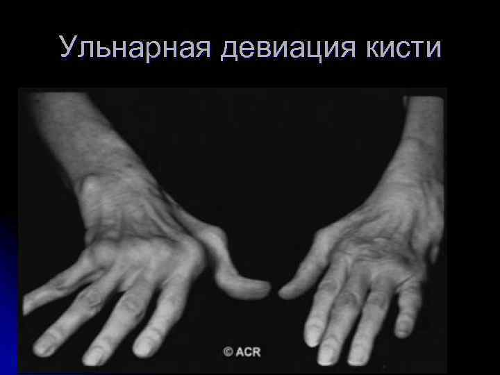 Ульнарная девиация кисти 