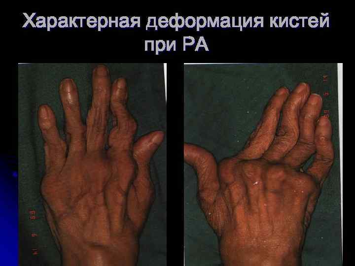 Характерная деформация кистей при РА 