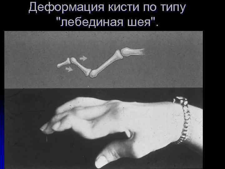 Деформация кисти по типу 