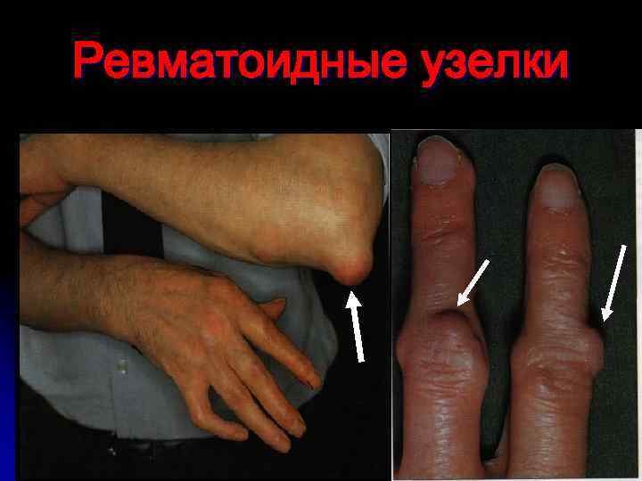 Ревматоидные узелки 