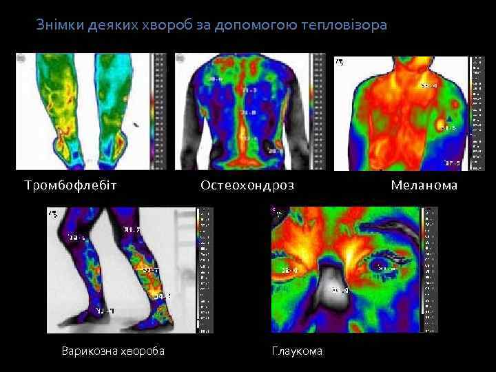 Знімки деяких хвороб за допомогою тепловізора Тромбофлебіт Остеохондроз Меланома Варикозна хвороба Глаукома 